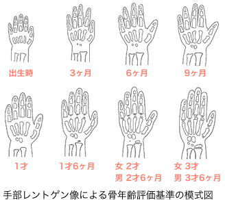コラム　骨年齢とは